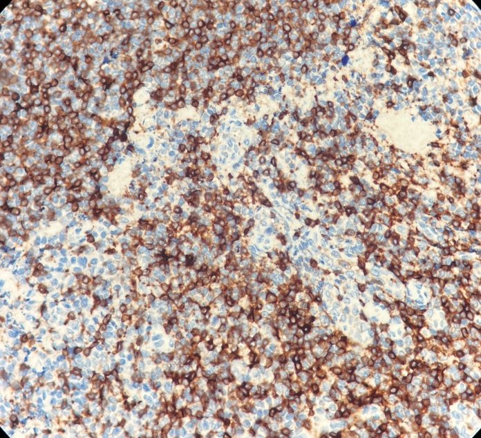 Marquage immunohistochimique anti-CD7 — Dartmon