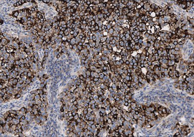Marquage immunohistochimique anti-MUC-1 — Dartmon