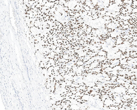 Marquage immunohistochimique anti-SALL4 — Dartmon