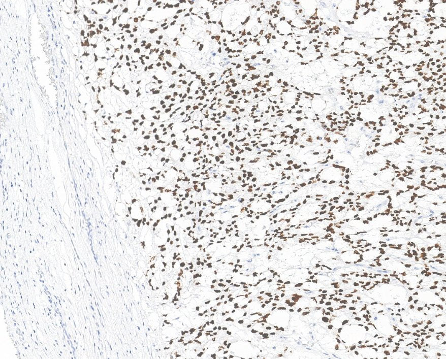 Marquage immunohistochimique anti-SALL4 — Dartmon