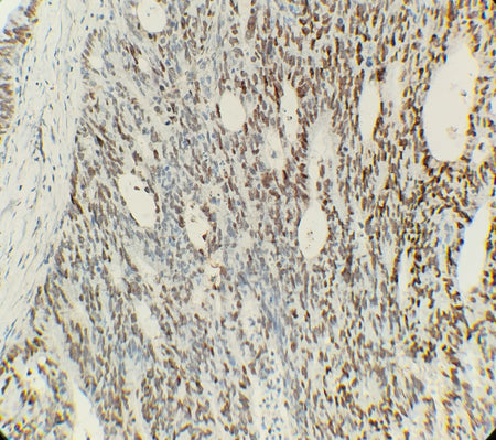 Marquage immunohistochimique anti-c-MYC — Dartmon
