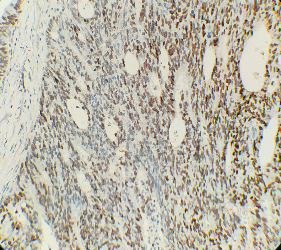 Marquage immunohistochimique anti-c-MYC — Dartmon