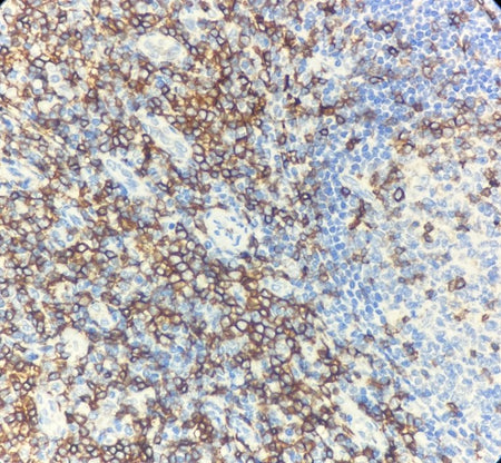 Marquage immunohistochimique anti-CD43 — Dartmon