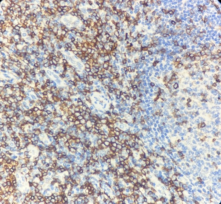 Marquage immunohistochimique anti-CD43 — Dartmon