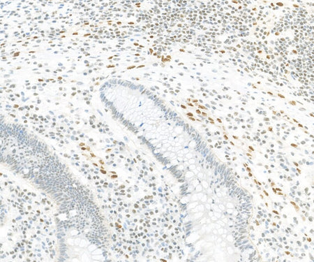 Marquage immunohistochimique anti-FLI-1 — Dartmon