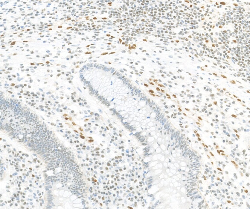 Marquage immunohistochimique anti-FLI-1 — Dartmon