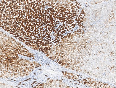 Marquage immunohistochimique anti-CK 8 & 18 — Dartmon