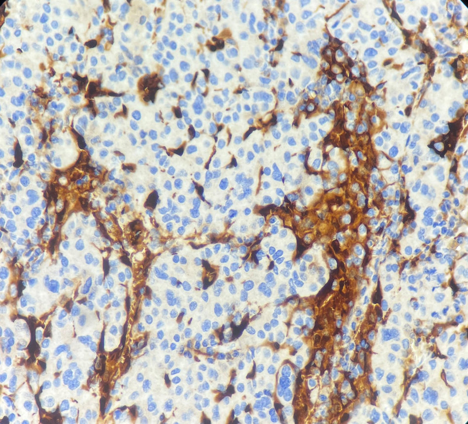Marquage immunohistochimique anti-Glypicane-3 — Dartmon