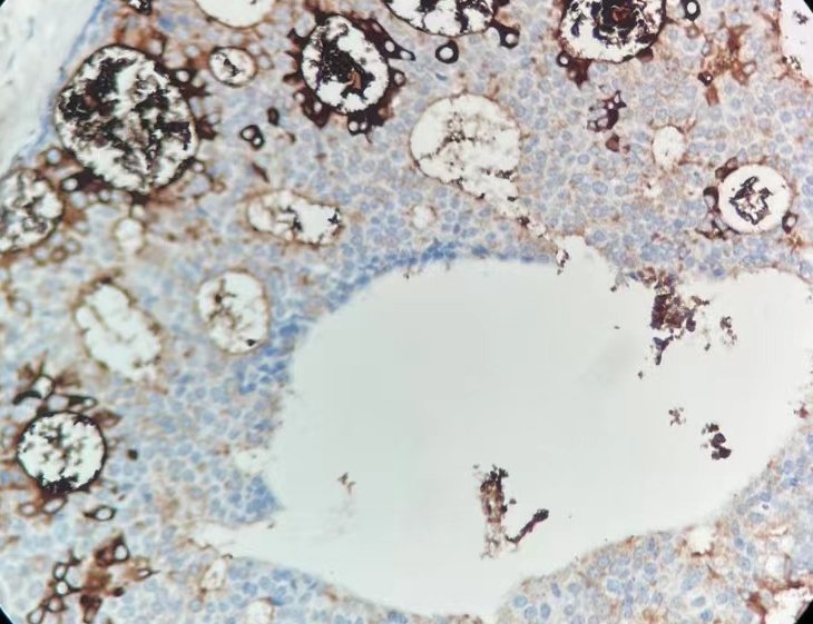 Marquage immunohistochimique anti-GCDFP-15 — Dartmon