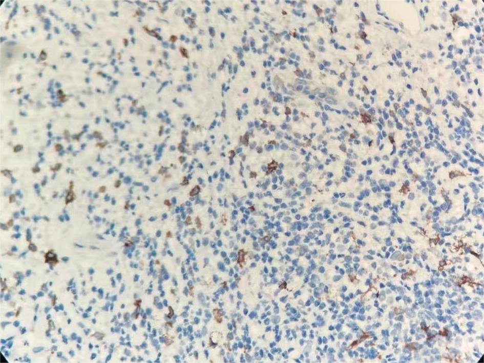 Marquage immunohistochimique anti-CD163 — Dartmon
