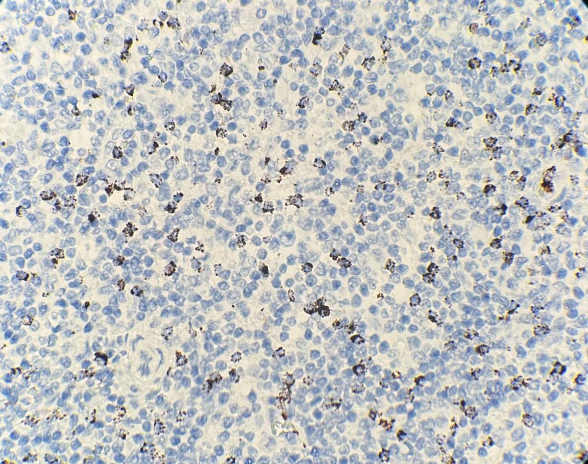 Marquage immunohistochimique anti-TIA-1 — Dartmon