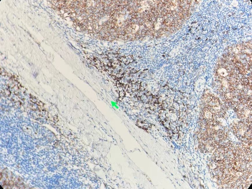 Marquage immunohistochimique anti-CD10 — Dartmon