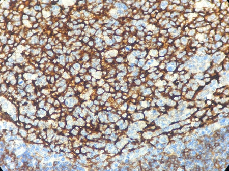 Marquage immunohistochimique anti-CD23 — Dartmon