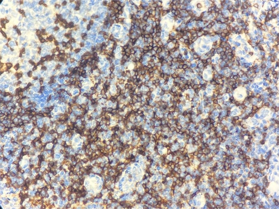 Marquage immunohistochimique anti-CD3 — Dartmon