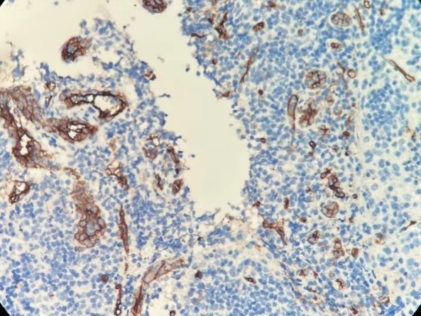 Marquage immunohistochimique anti-CD34 — Dartmon