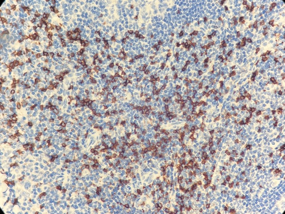 Marquage immunohistochimique anti-CD8 — Dartmon