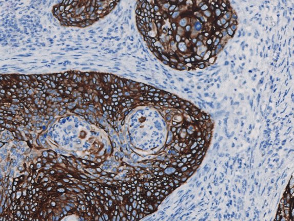 Marquage immunohistochimique anti-CK14 — Dartmon
