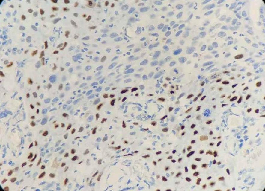 Marquage immunohistochimique anti-p40 — Dartmon
