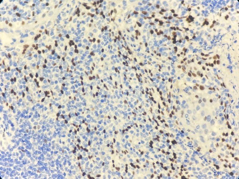 Marquage immunohistochimique anti-p63 — Dartmon