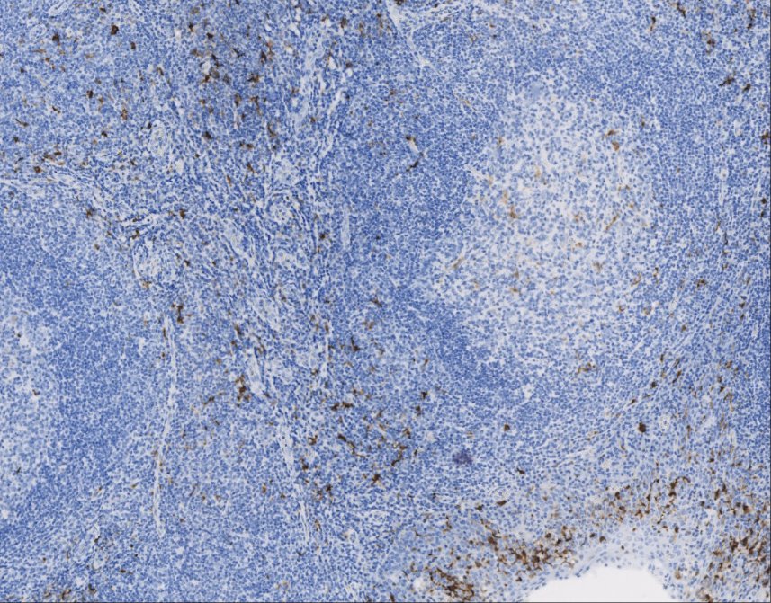 Marquage immunohistochimique anti-S100 — Dartmon