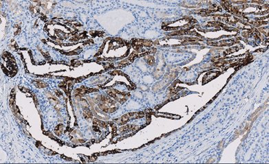 Marquage immunohistochimique anti-Thyroglobuline — Dartmon