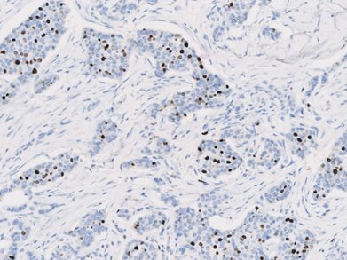 Marquage immunohistochimique anti-TOP2A — Dartmon