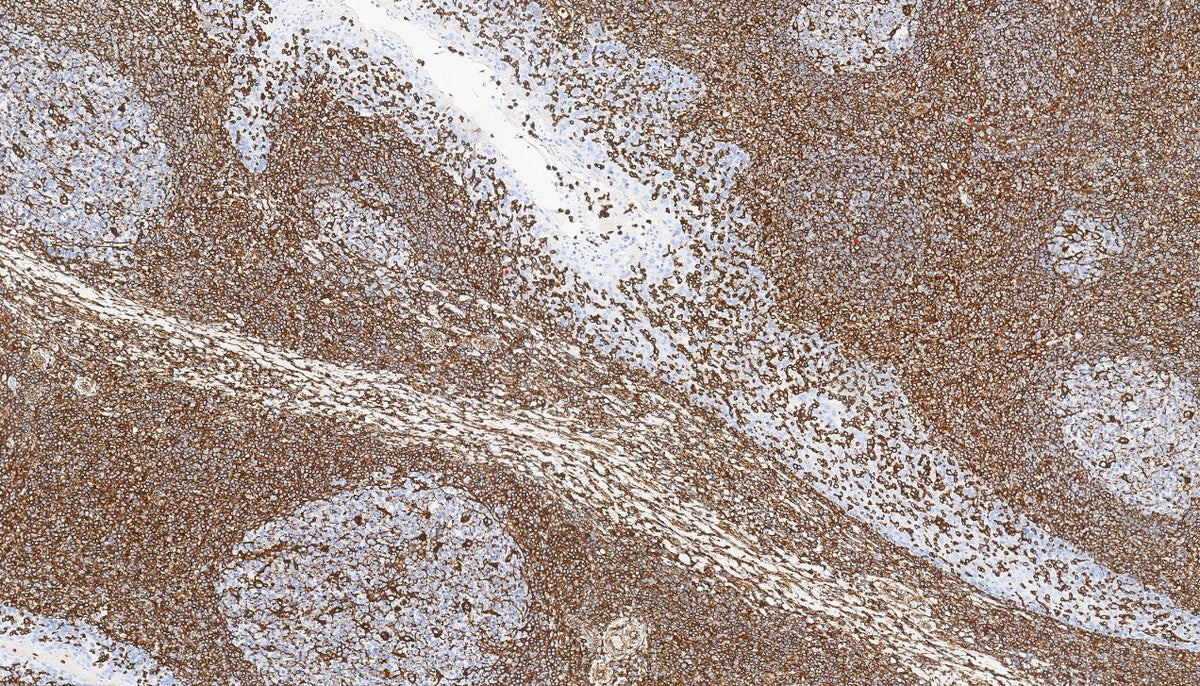 Marquage immunohistochimique anti-VIM — Dartmon