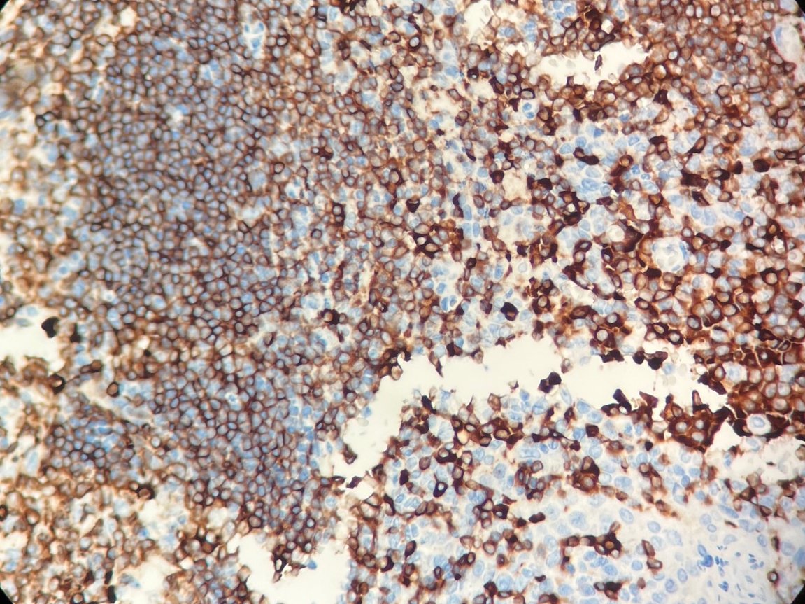 Marquage immunohistochimique anti-CD79a — Dartmon