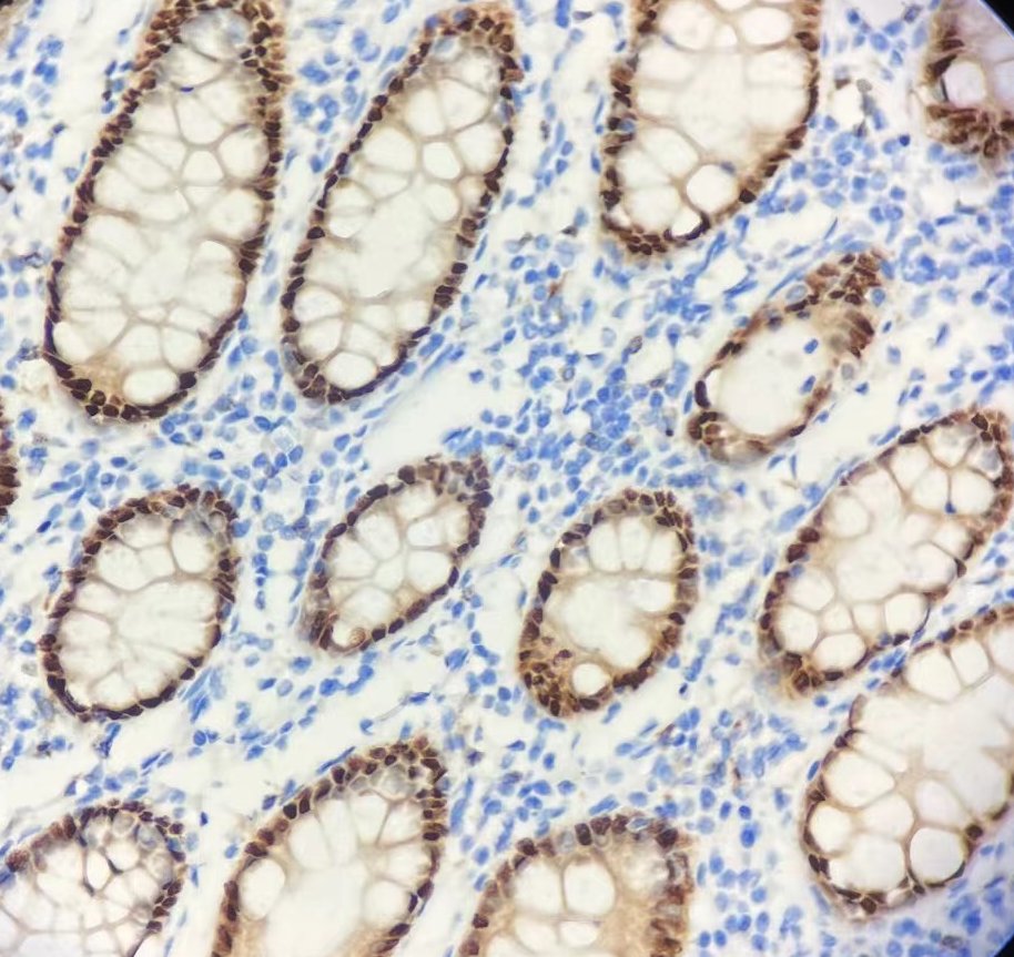 Marquage immunohistochimique anti-CDX-2 — Dartmon