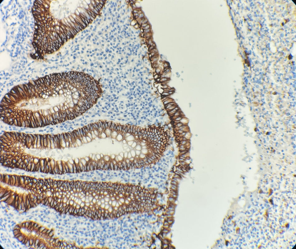 Marquage immunohistochimique anti-Ep-CAM — Dartmon