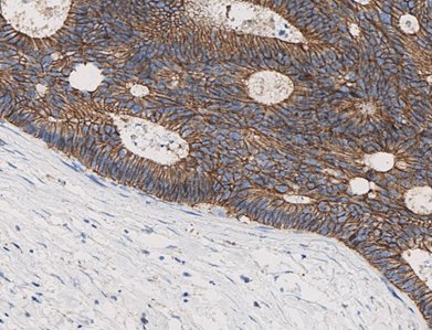 Marquage immunohistochimique anti-p120 — Dartmon