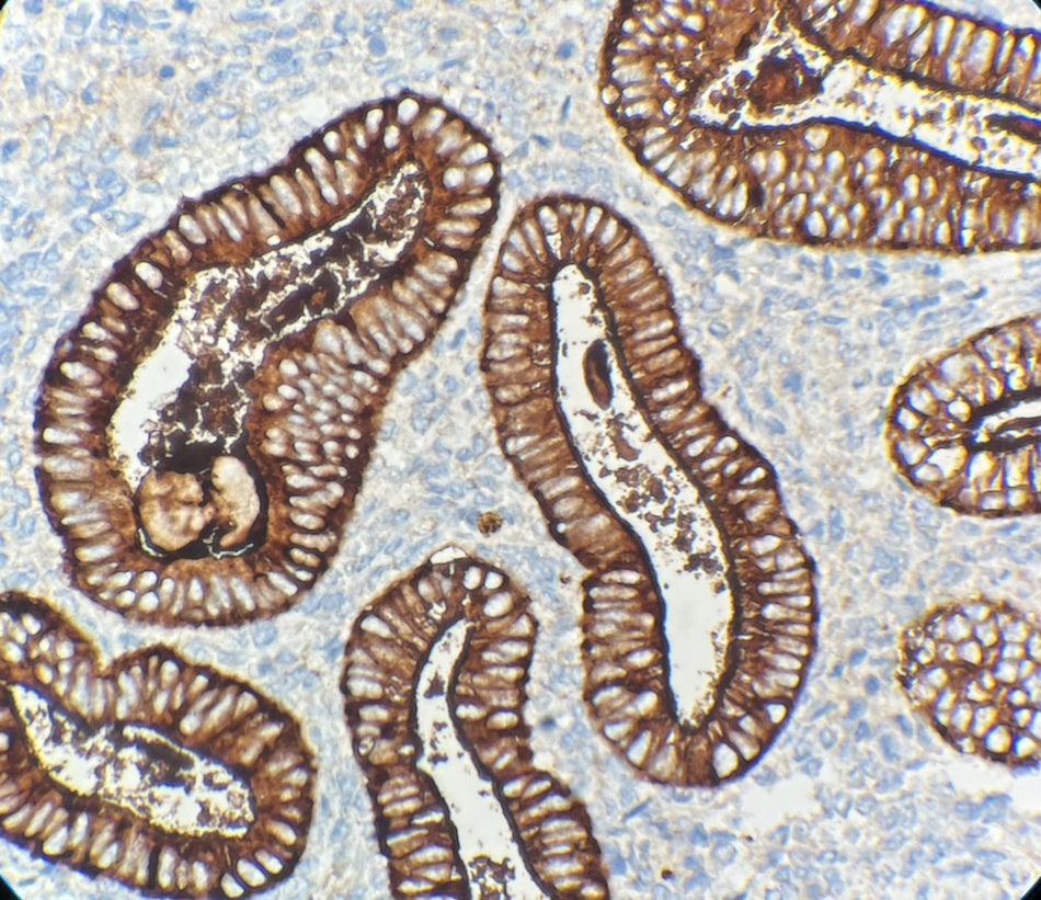Marquage immunohistochimique anti-CA 125 — Dartmon