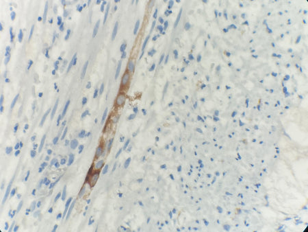 Marquage immunohistochimique anti-ALK — Dartmon