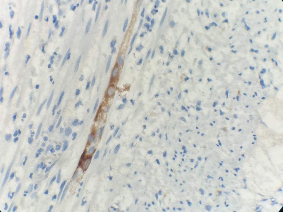 Marquage immunohistochimique anti-ALK — Dartmon