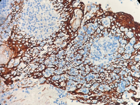 Marquage immunohistochimique anti-CK5&6 — Dartmon