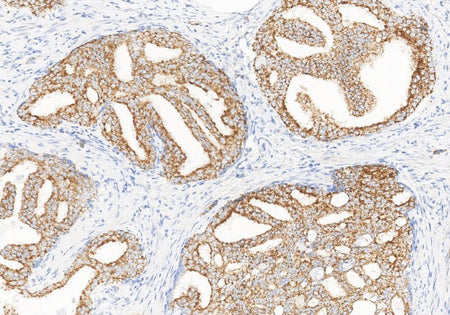 Marquage immunohistochimique anti-AMACR/p504s — Dartmon