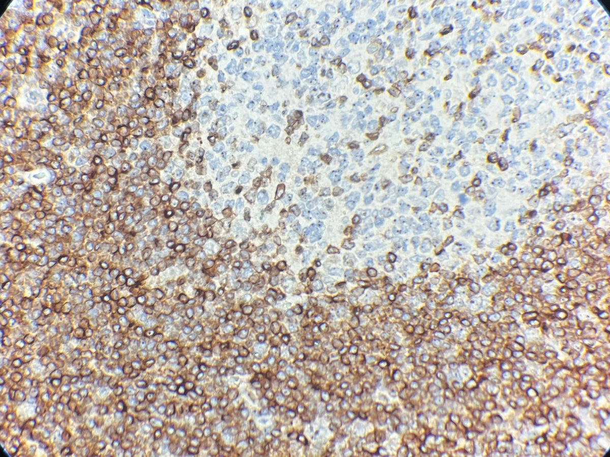 Marquage immunohistochimique anti-Bcl-2 — Dartmon