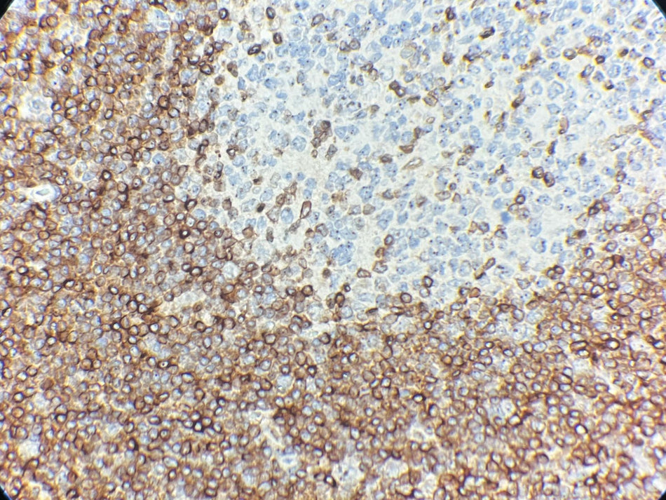 Marquage immunohistochimique anti-Bcl-2 — Dartmon