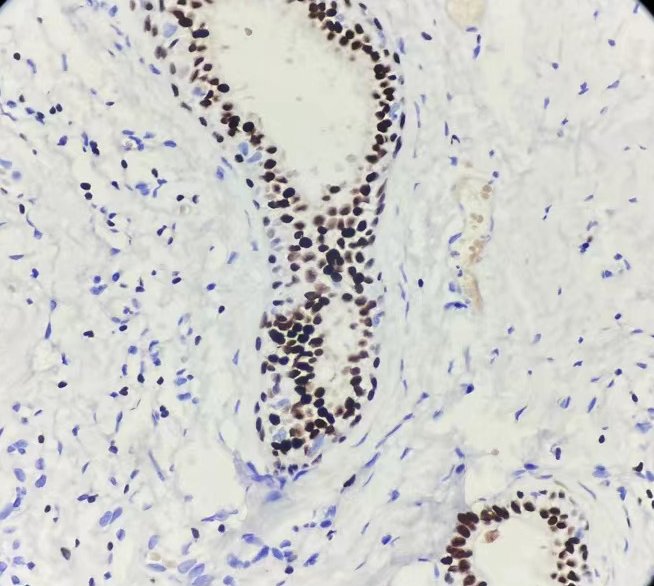 Marquage immunohistochimique anti-GATA3 — Dartmon
