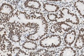 Marquage immunohistochimique anti-MSH2 — Dartmon