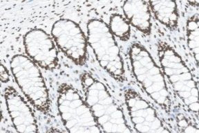 Marquage immunohistochimique anti-MSH6 — Dartmon