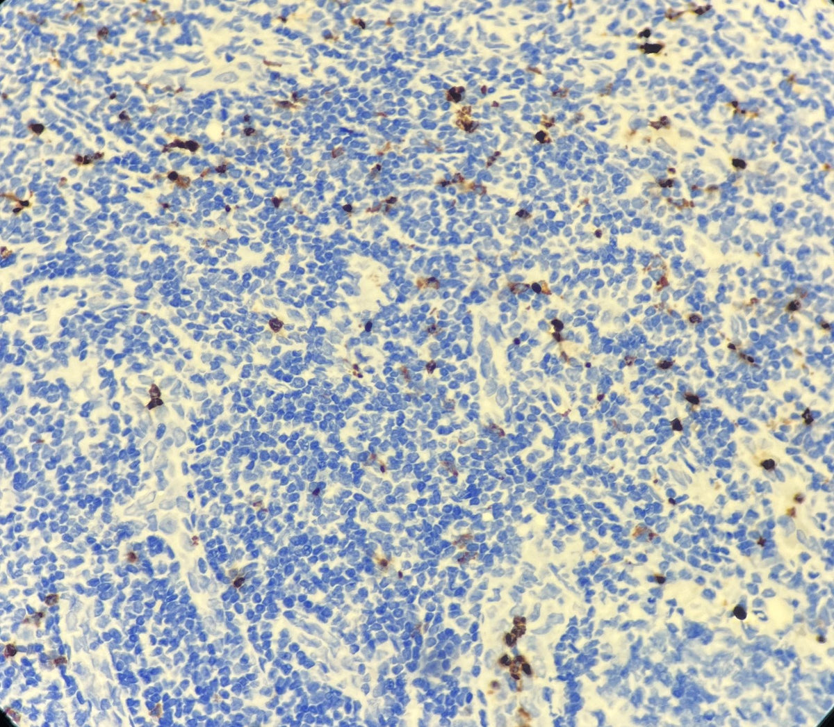 Marquage immunohistochimique anti-Myéloperoxydase — Dartmon
