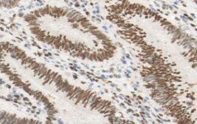 Marquage immunohistochimique anti-PMS2 — Dartmon