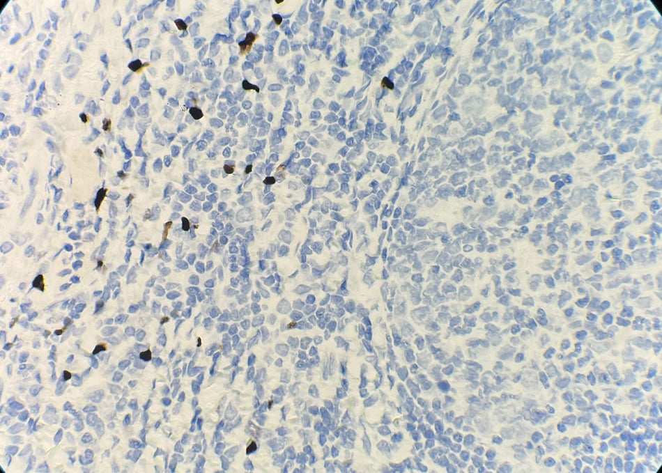 Marquage immunohistochimique anti-TdT — Dartmon