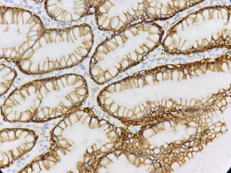 Marquage immunohistochimique anti-Bêta-caténine — Dartmon
