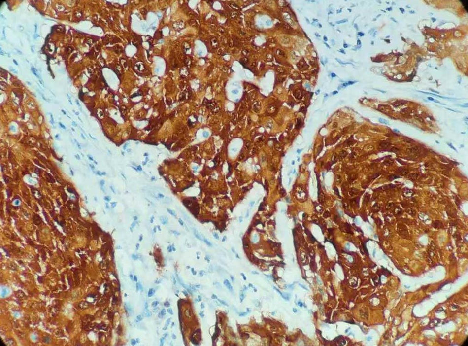 Marquage immunohistochimique anti-p16 — Dartmon