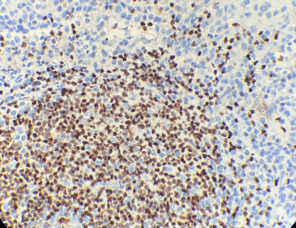 Marquage immunohistochimique anti-Pax-5 — Dartmon