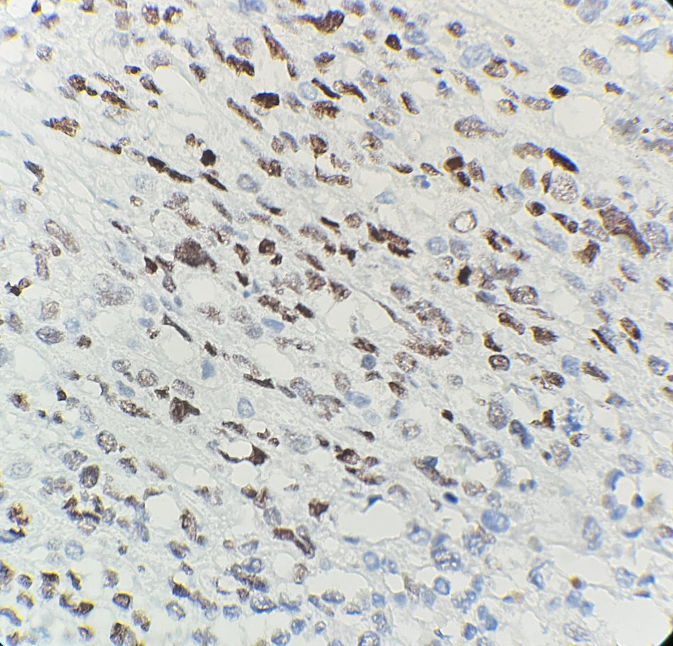 Marquage immunohistochimique anti-Myo D1 — Dartmon