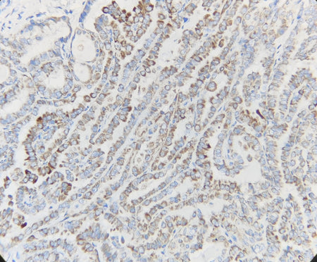 Marquage immunohistochimique anti-BRAF — Dartmon