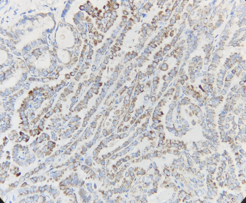 Marquage immunohistochimique anti-BRAF — Dartmon